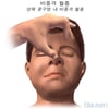 비중격 혈종