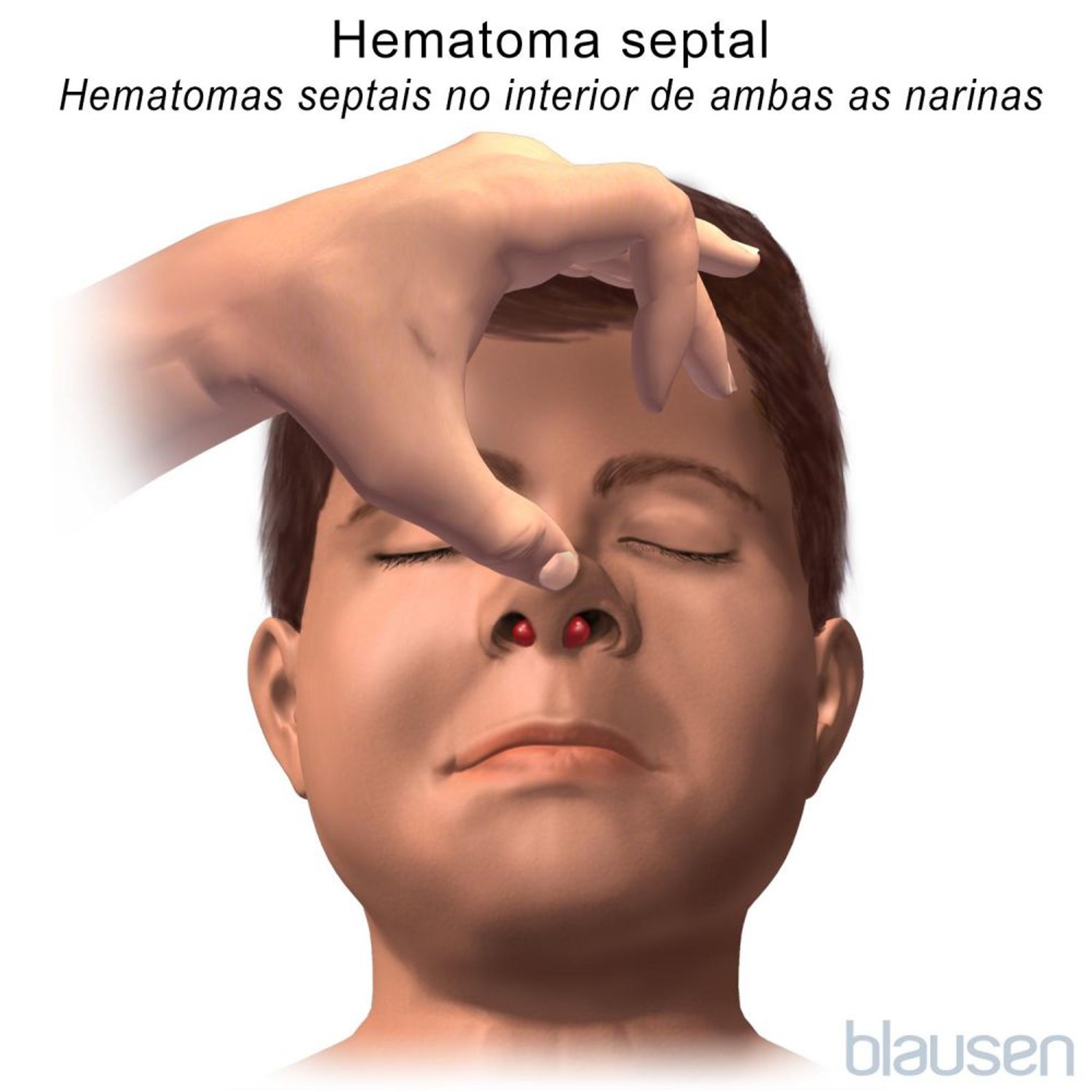 Hematoma do septo