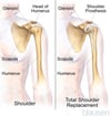 Total Shoulder Replacement (Arthroplasty)