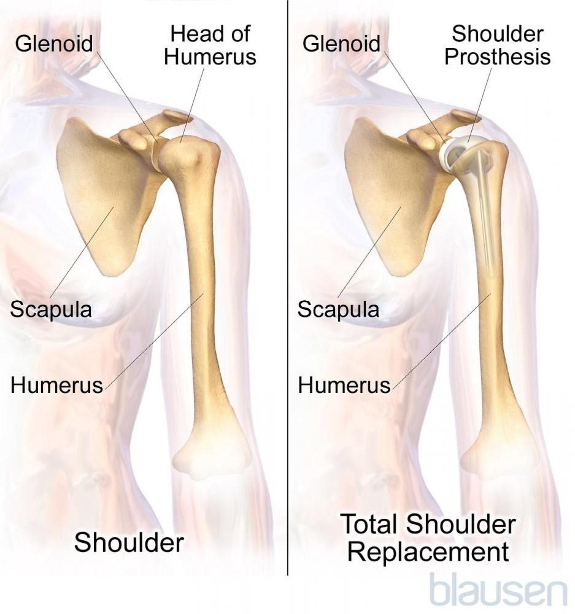 Total Shoulder Replacement (Arthroplasty)