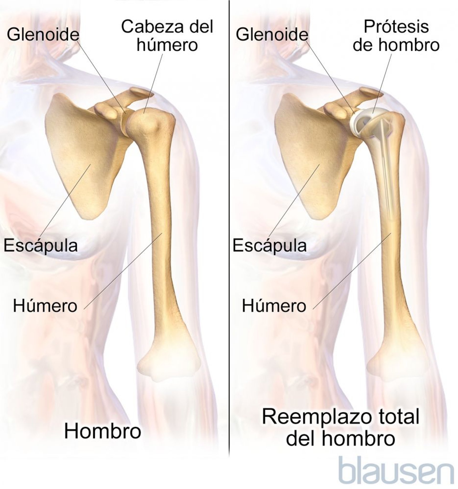 Reemplazo total de hombro (artroplastia)