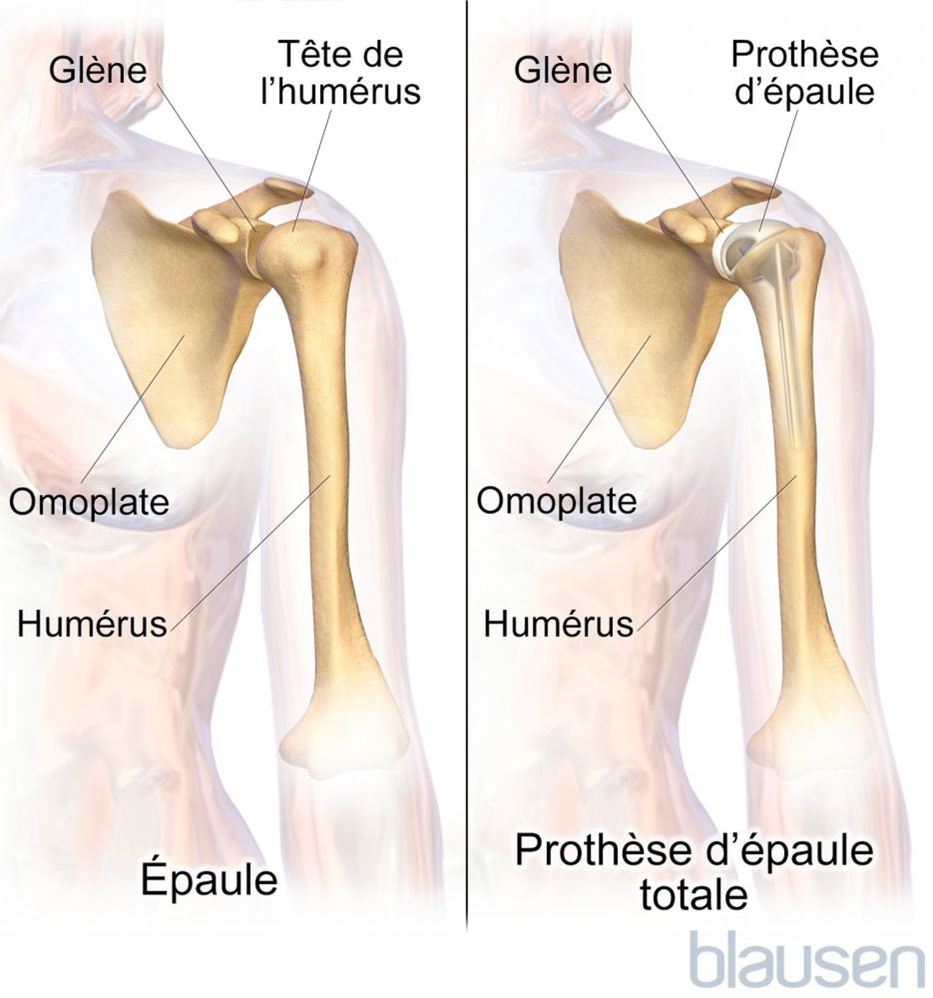 Prothèse totale de l’épaule (arthroplastie)