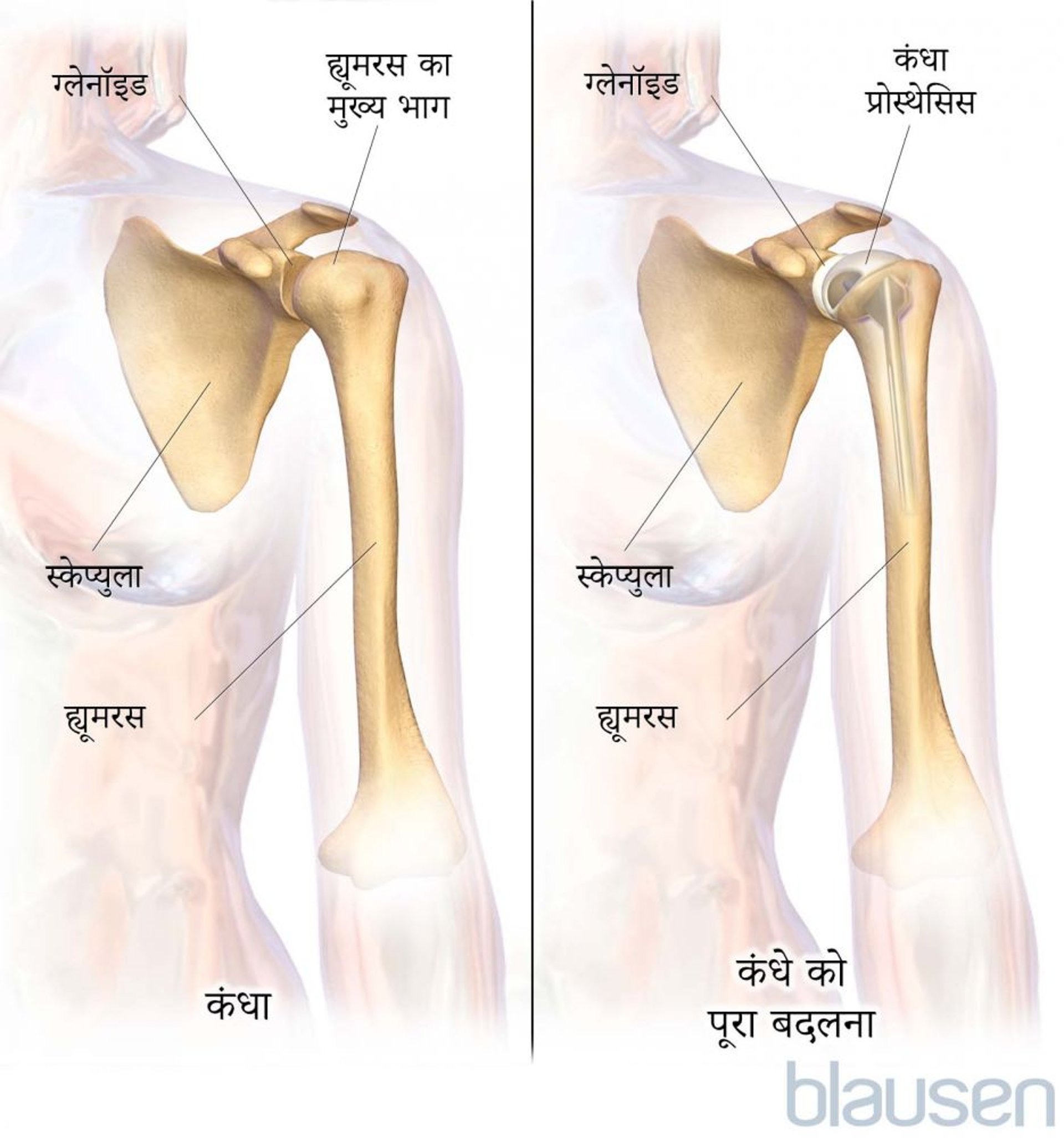 कंधे को संपूर्ण रूप से बदलना (आर्थ्रोप्लास्टी)