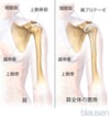 肩関節全置換術（関節形成術）
