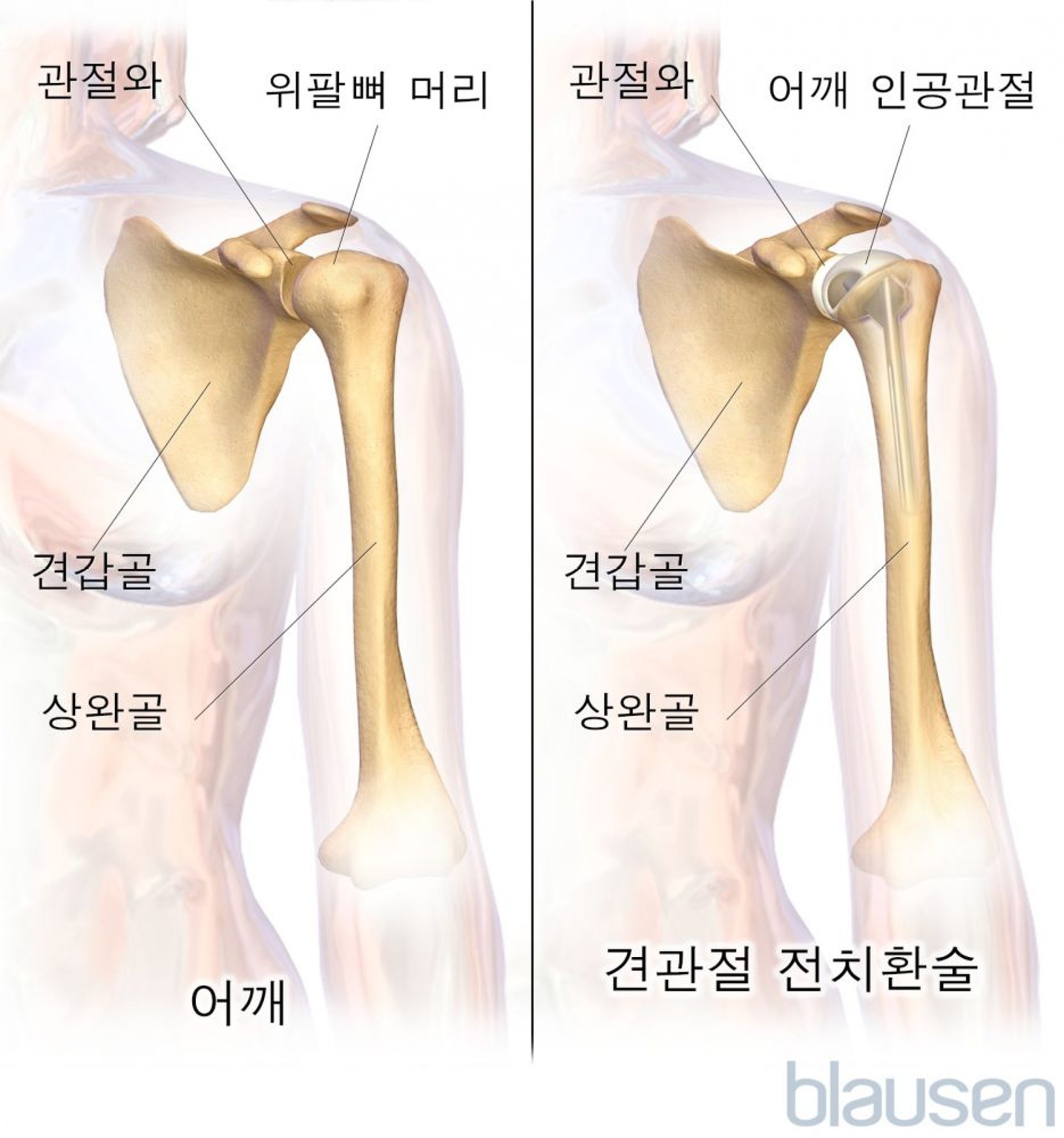 견관절 전치환술(관절성형술)