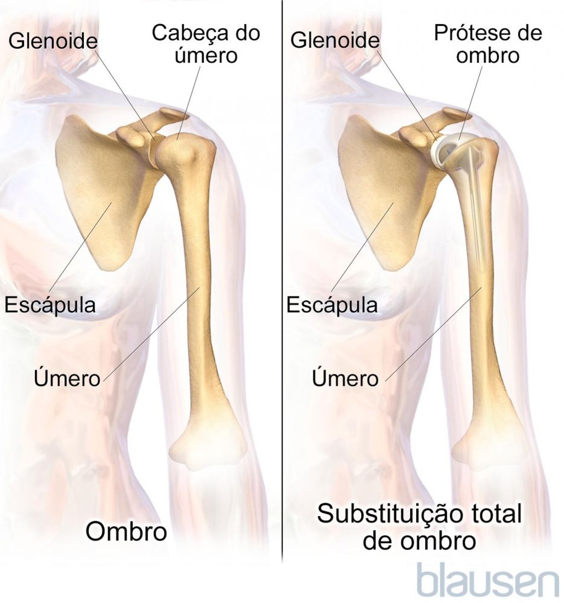 Substituição total de ombro (artroplastia)