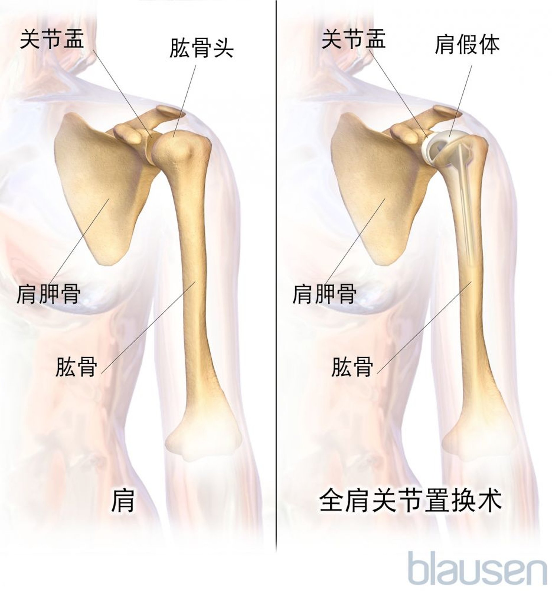 全肩置换术（关节成形术）