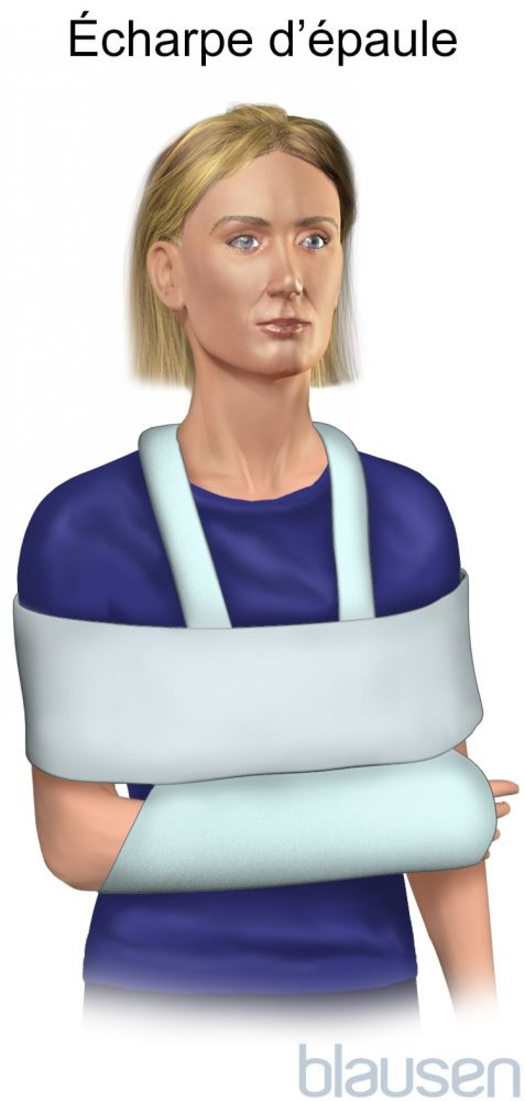 Immobilisation de l’épaule