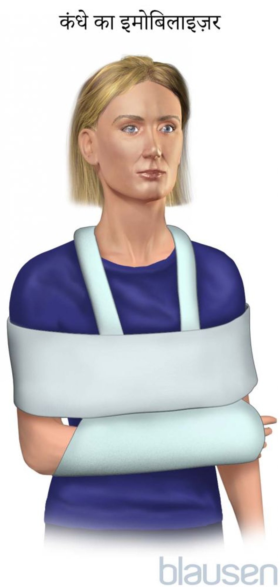 कंधे का इमोबिलाइज़र