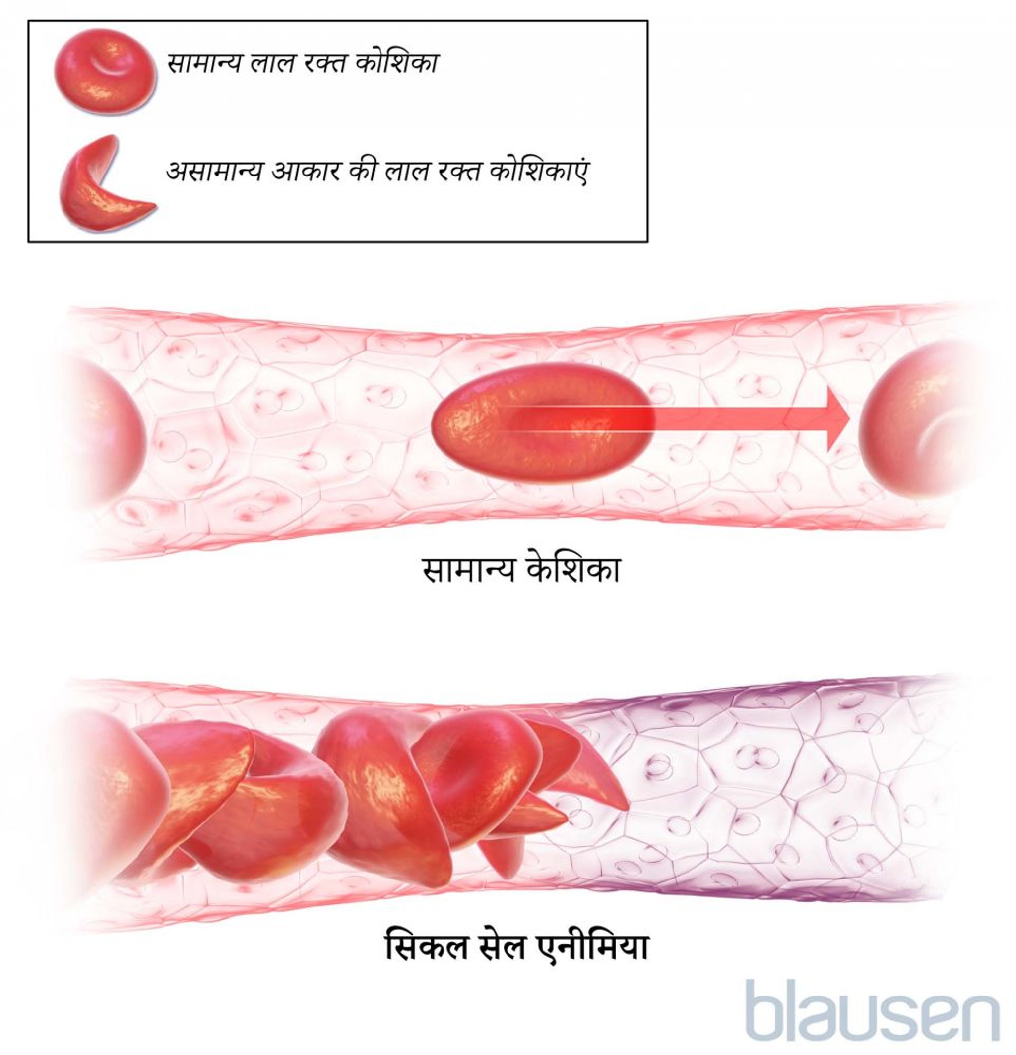 सिकल सेल रोग