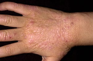 Lichenifikation
