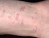 Papules