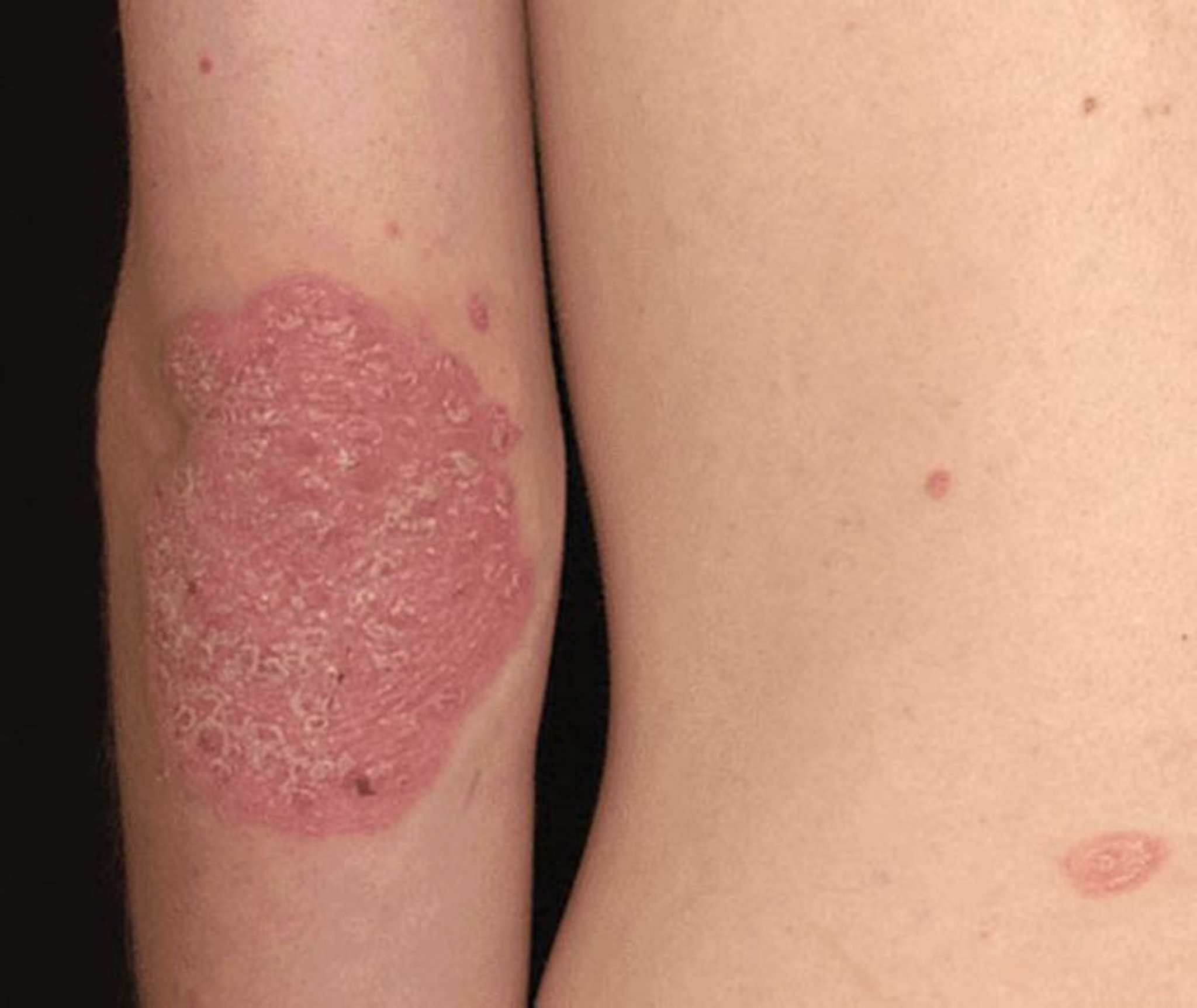 Red Patch in Psoriasis