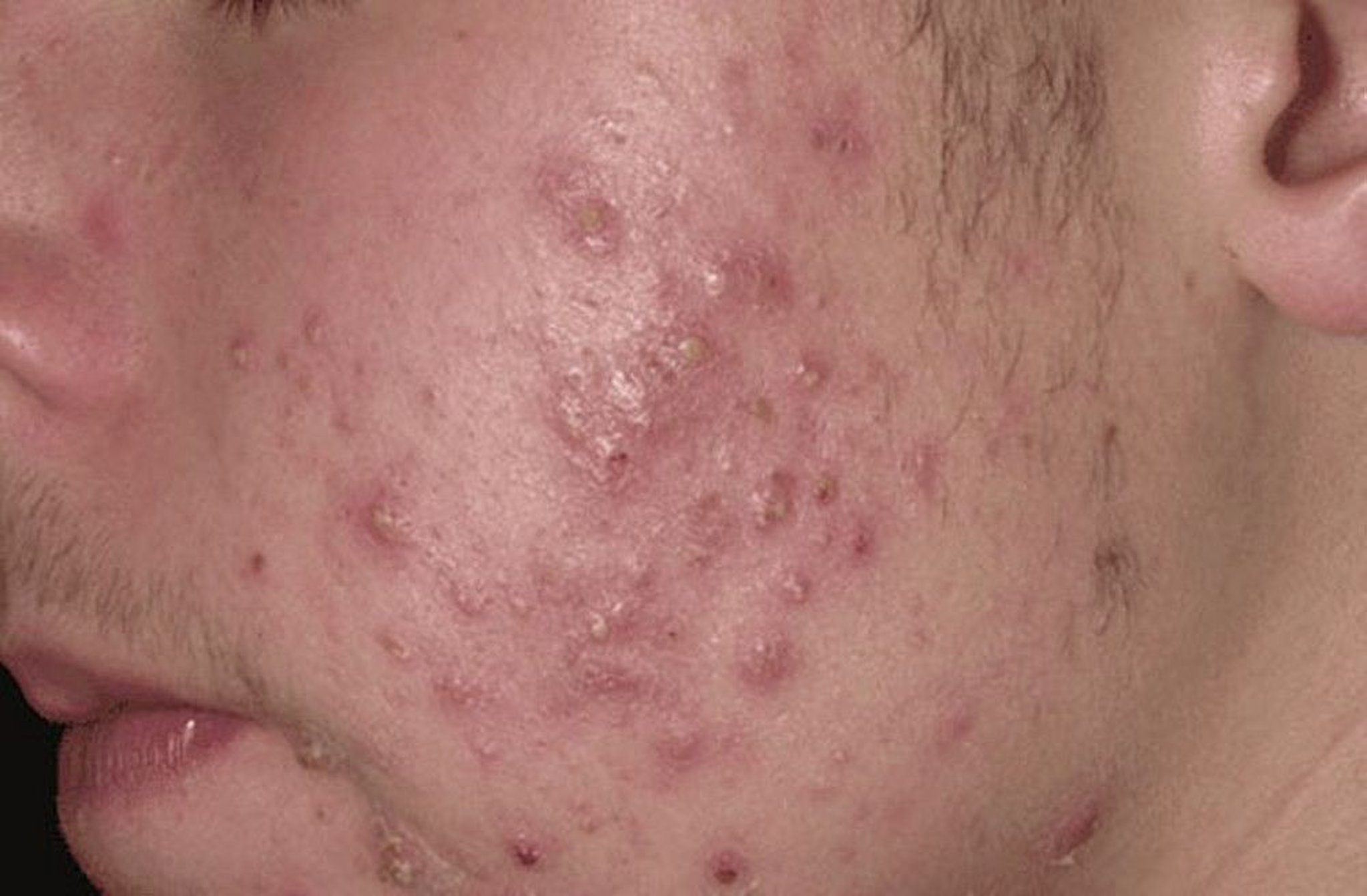 Pustules