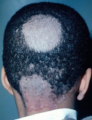 Escamas y pérdida de cabello (en la tiña del cuero cabelludo)