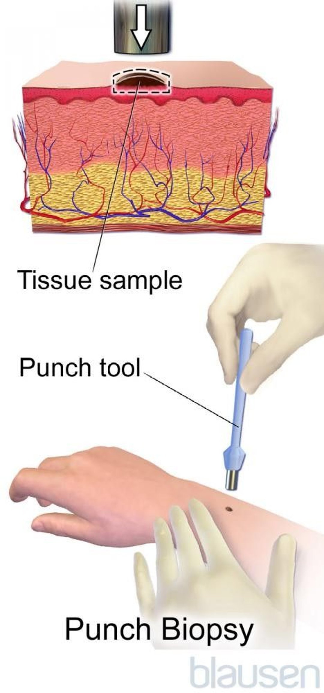 Punch Biopsy