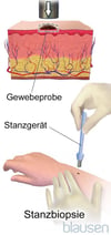 Stanzbiopsie