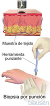 Biopsia con sacabocados