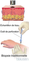 Biopsie traditionnelle