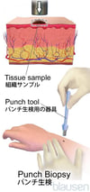 パンチ生検