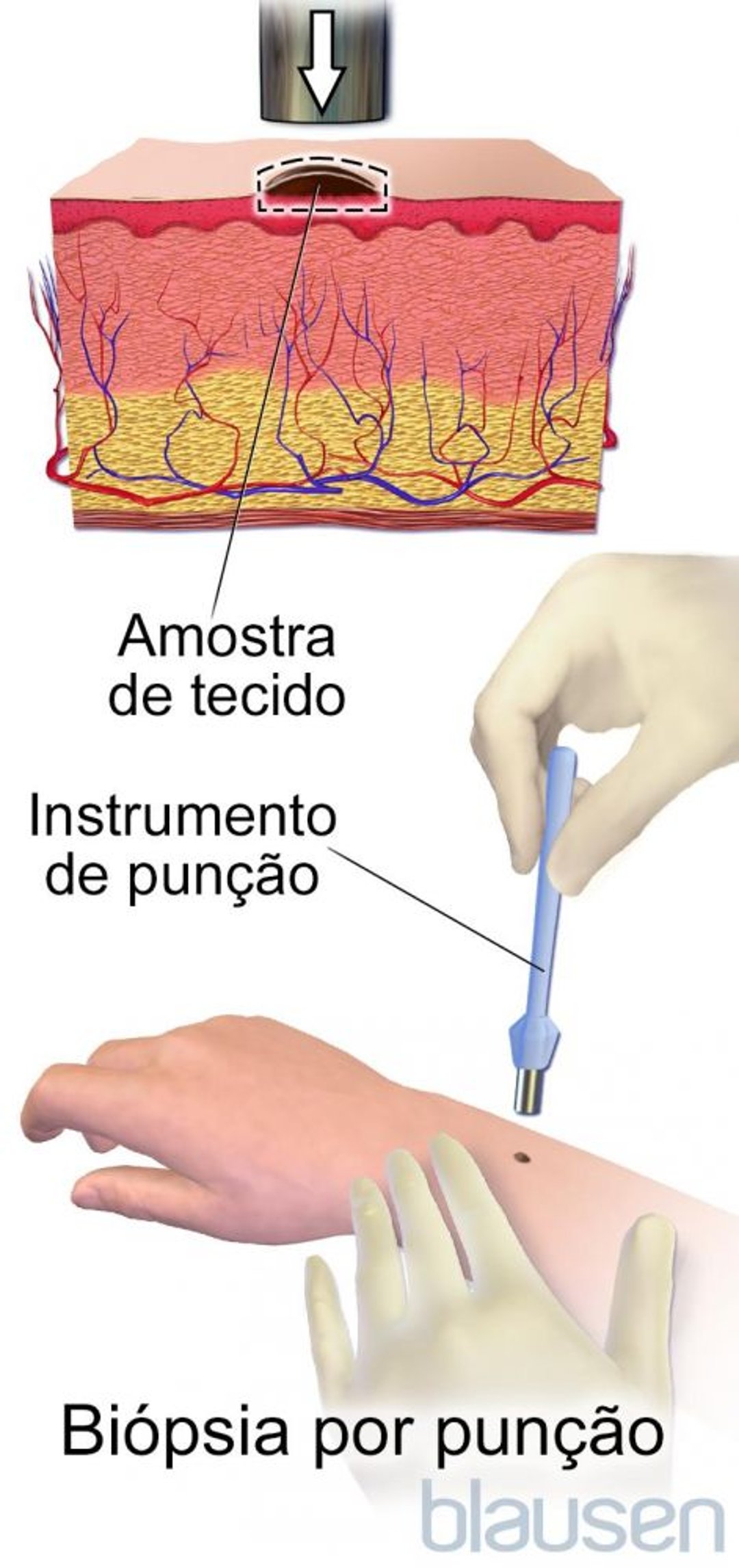 Biópsia por punção