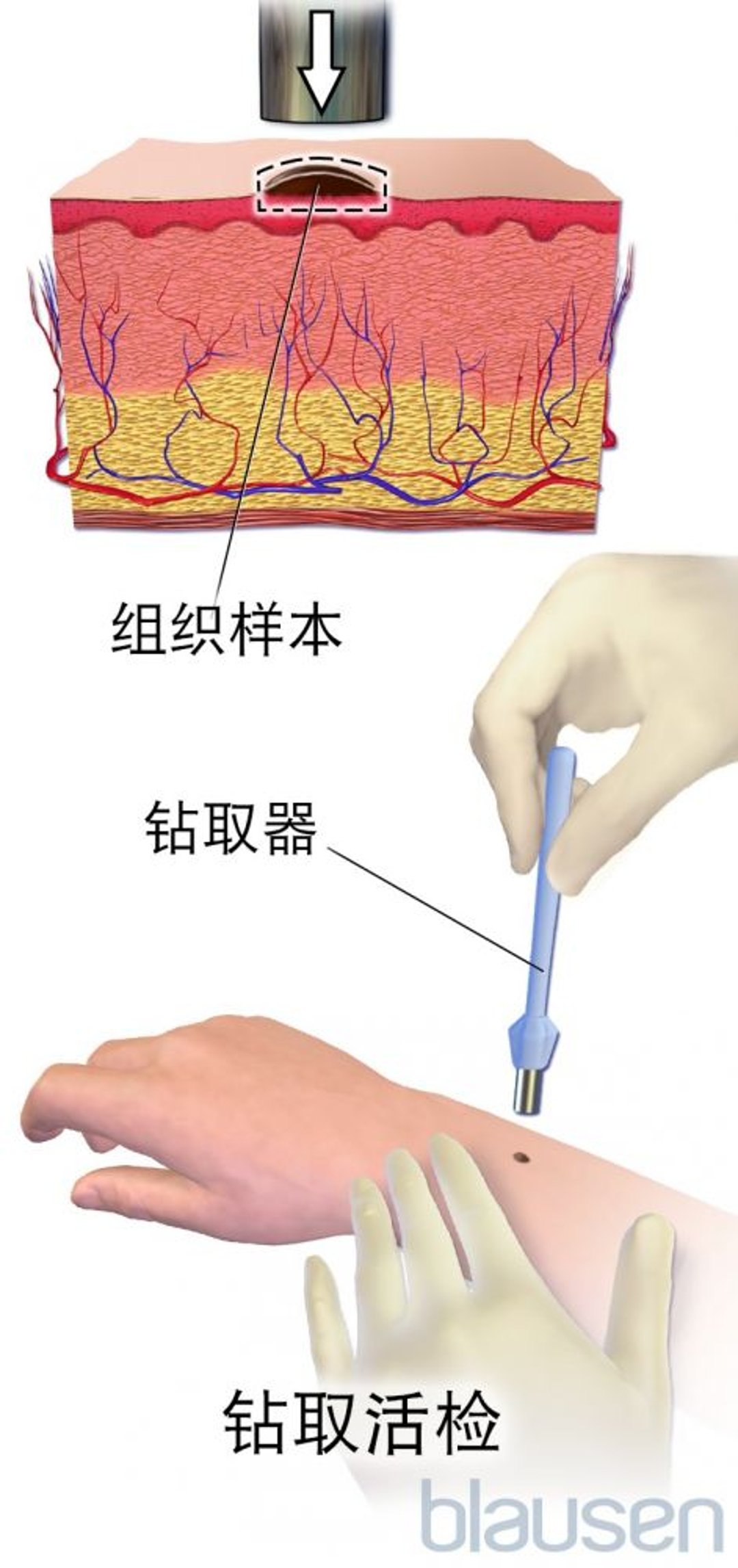 钻取活检
