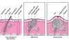 Comparing Mild Acne and Severe Acne