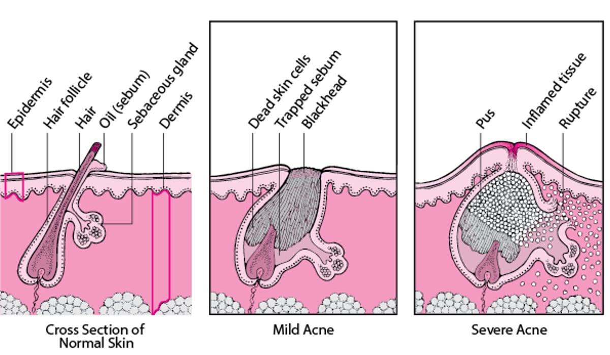 Comparing Mild Acne and Severe Acne