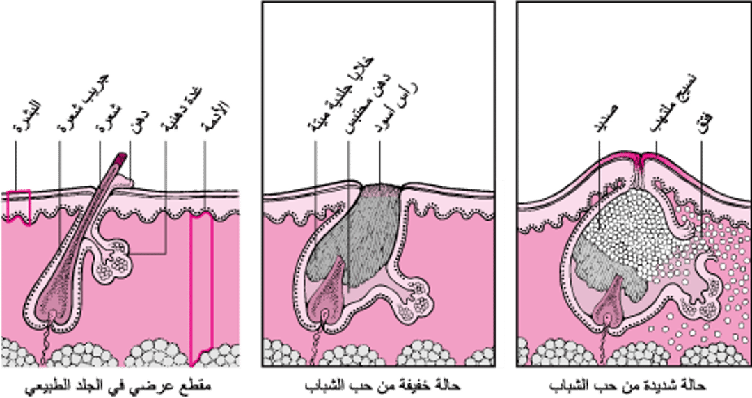 مُقارنة حب الشباب الخفيف بحبّ الشَّباب الشديد
