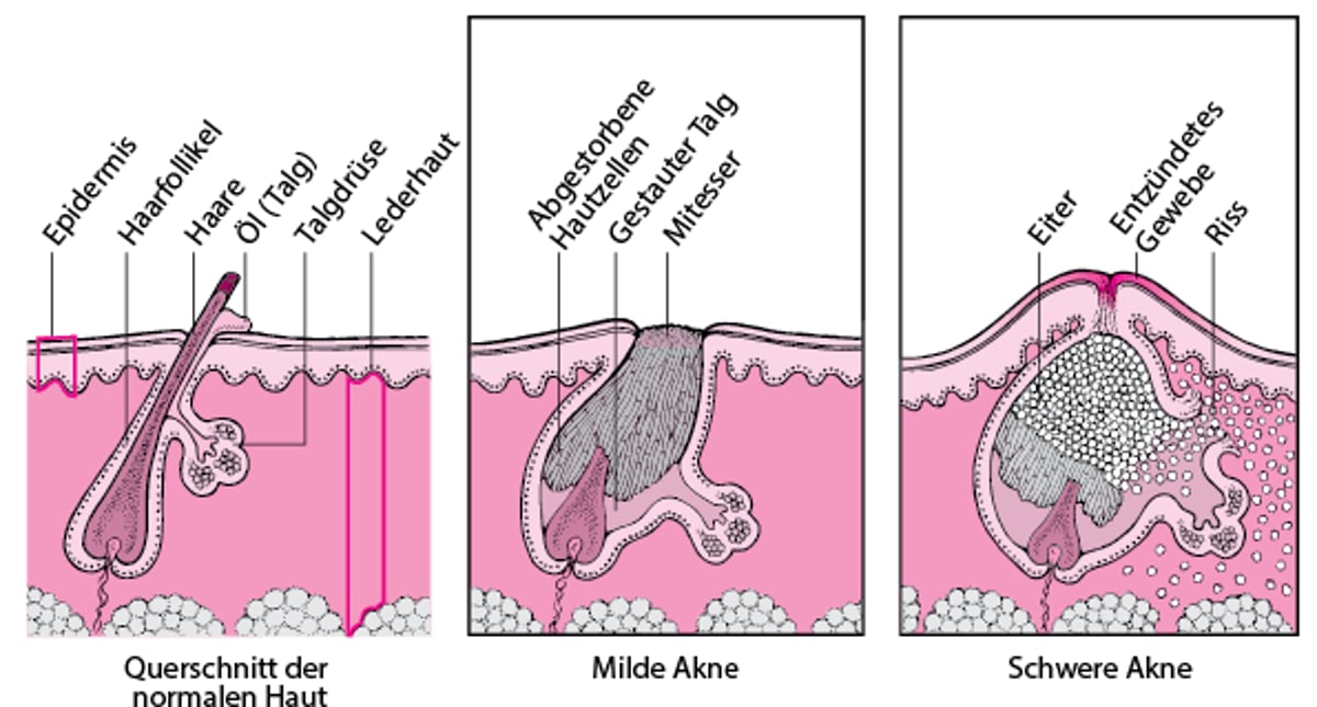Unterschiede zwischen leichter und schwerer Akne