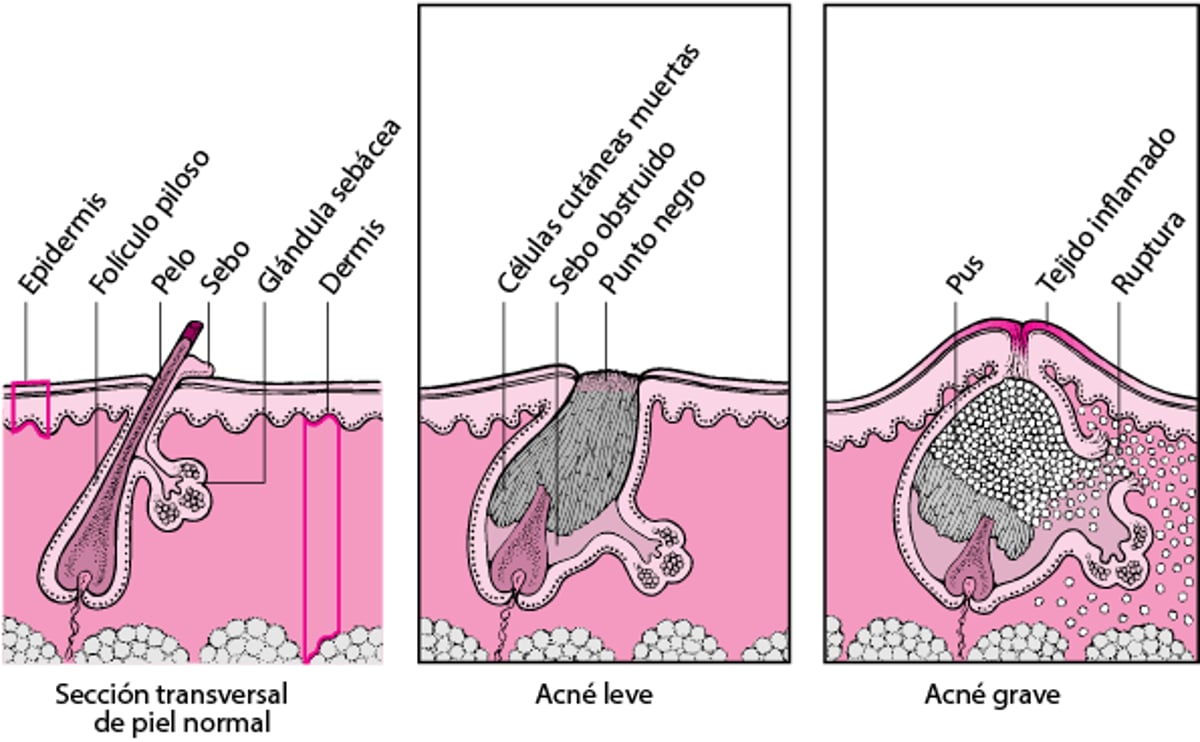 Comparación entre el acné leve y el acné grave