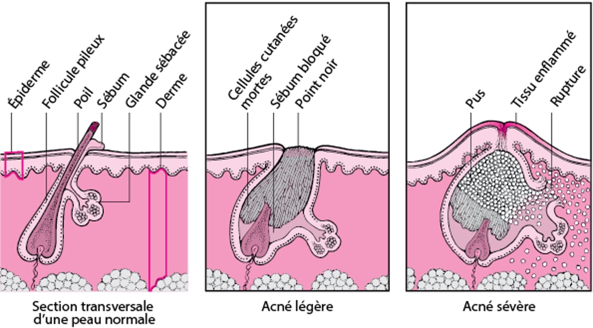 Comparaison entre acné modérée et grave