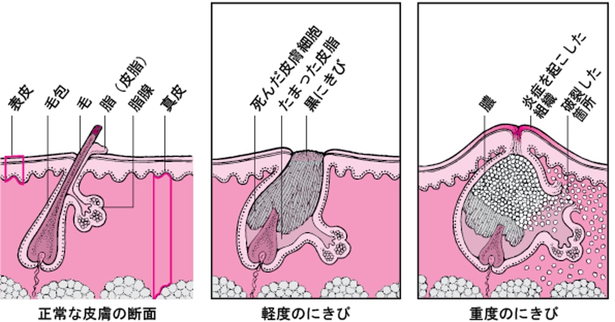 軽度のにきびと重度のにきびの比較