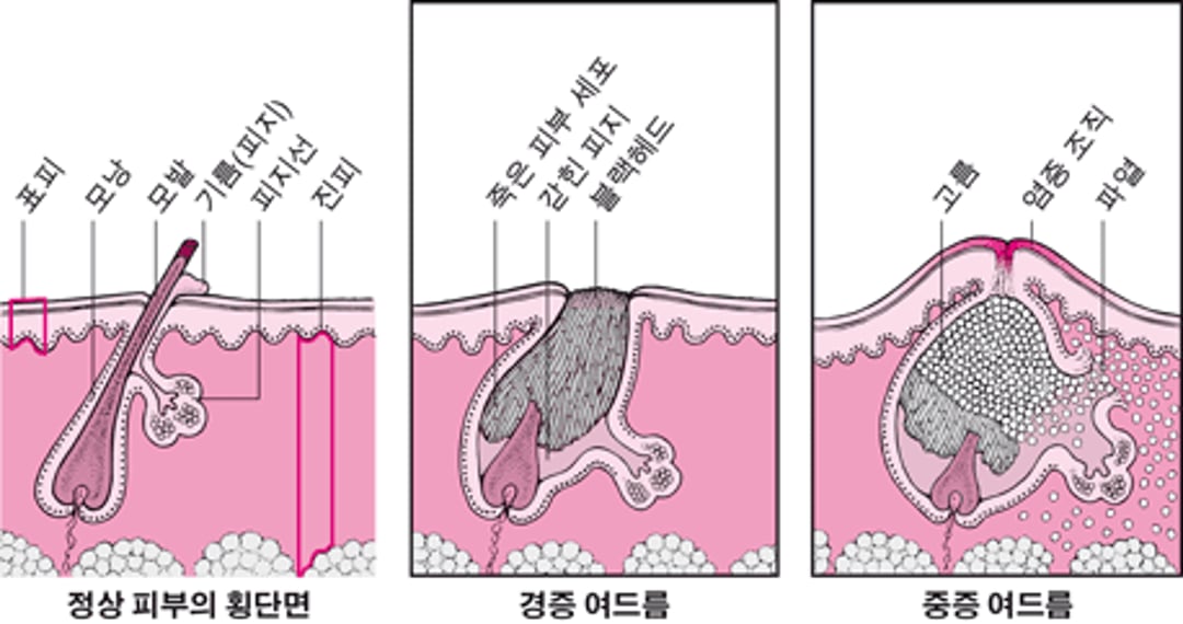 경증 여드름과 중증 여드름 비교