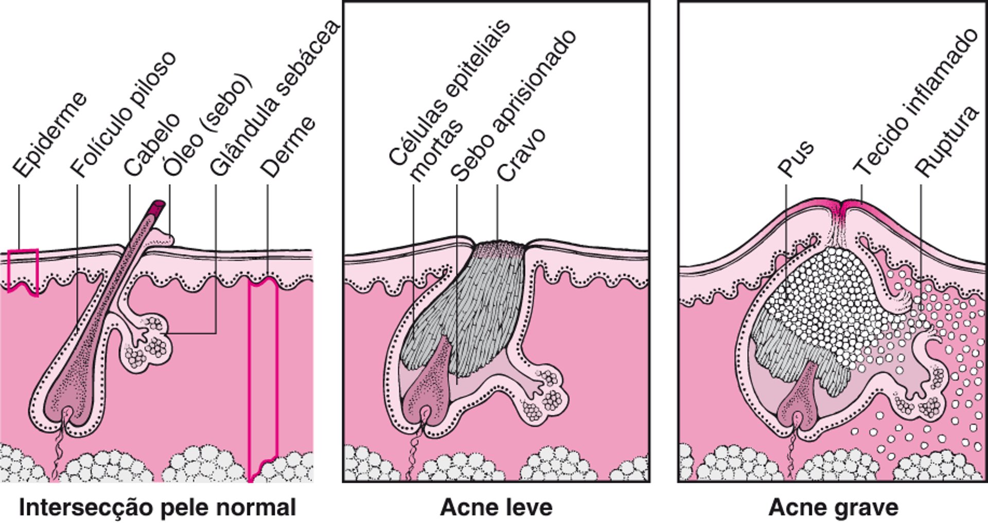 Comparação entre acne leve e acne grave