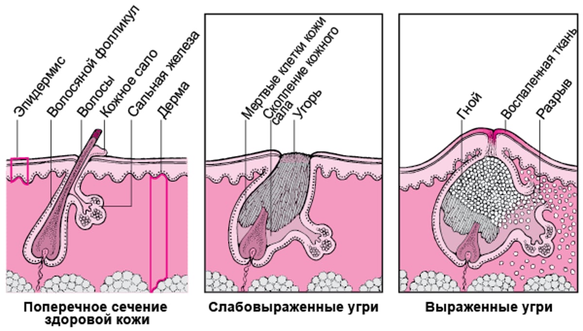 Сравнение степеней тяжести угревой сыпи