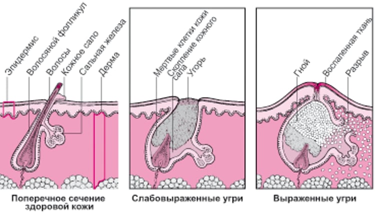 Сравнение степеней тяжести угревой сыпи