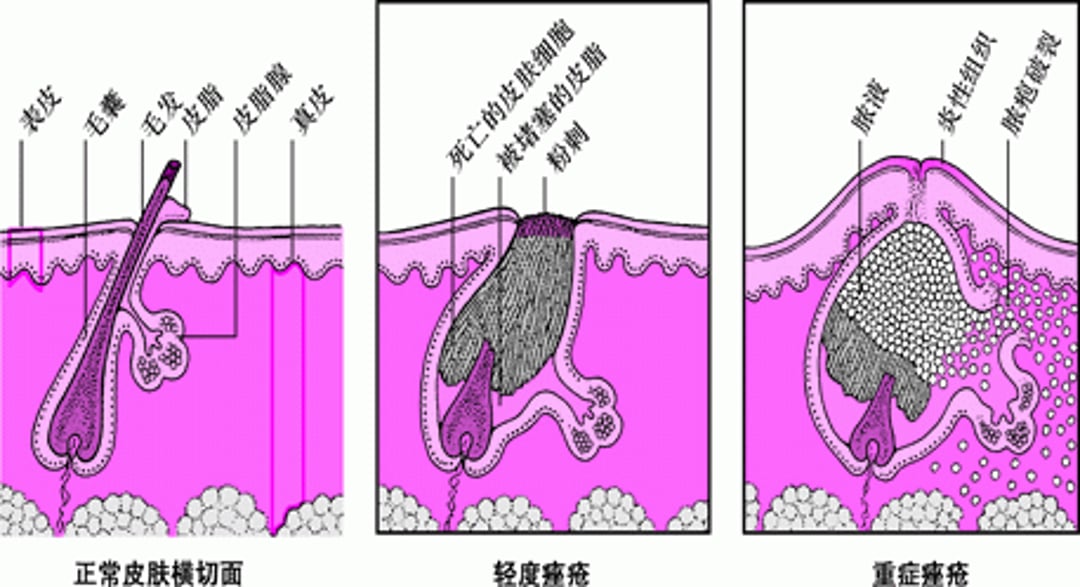 轻度痤疮与重度痤疮比较