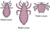 A Close-Up Look at Lice