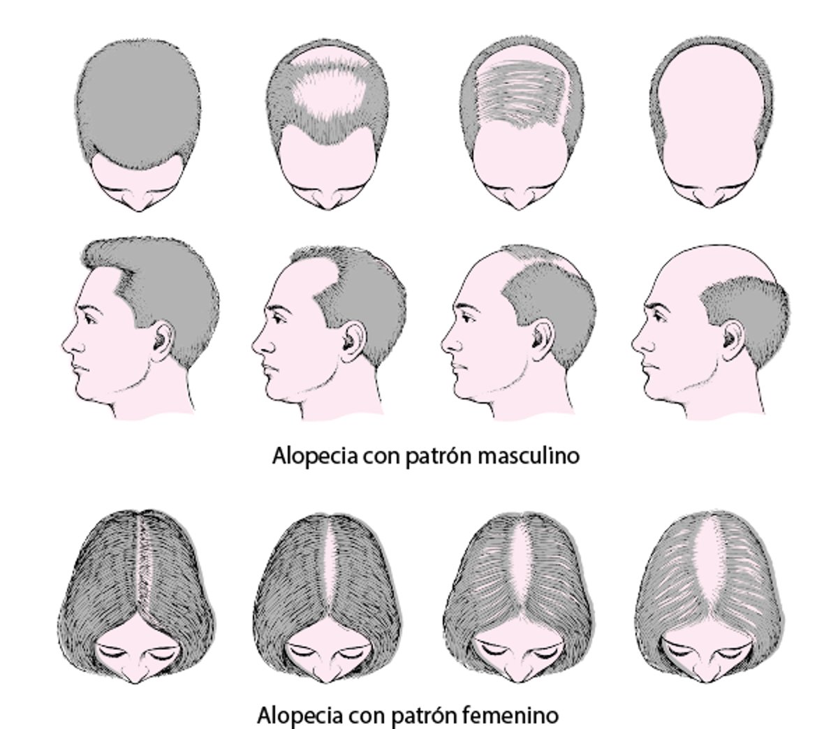 Patrones de pérdida del cabello
