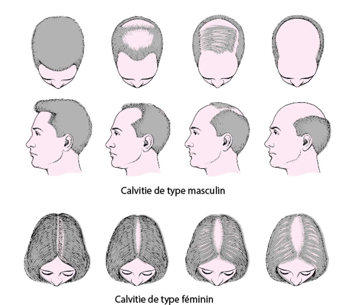 Chute de cheveux