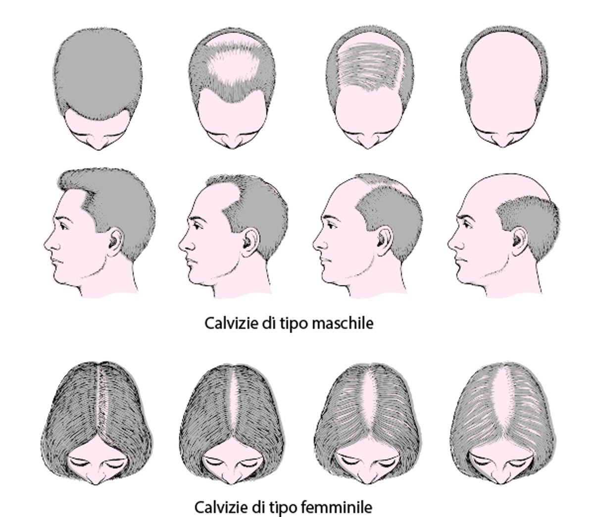 Perdita di capelli