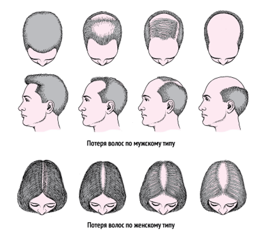 Выпадение волос