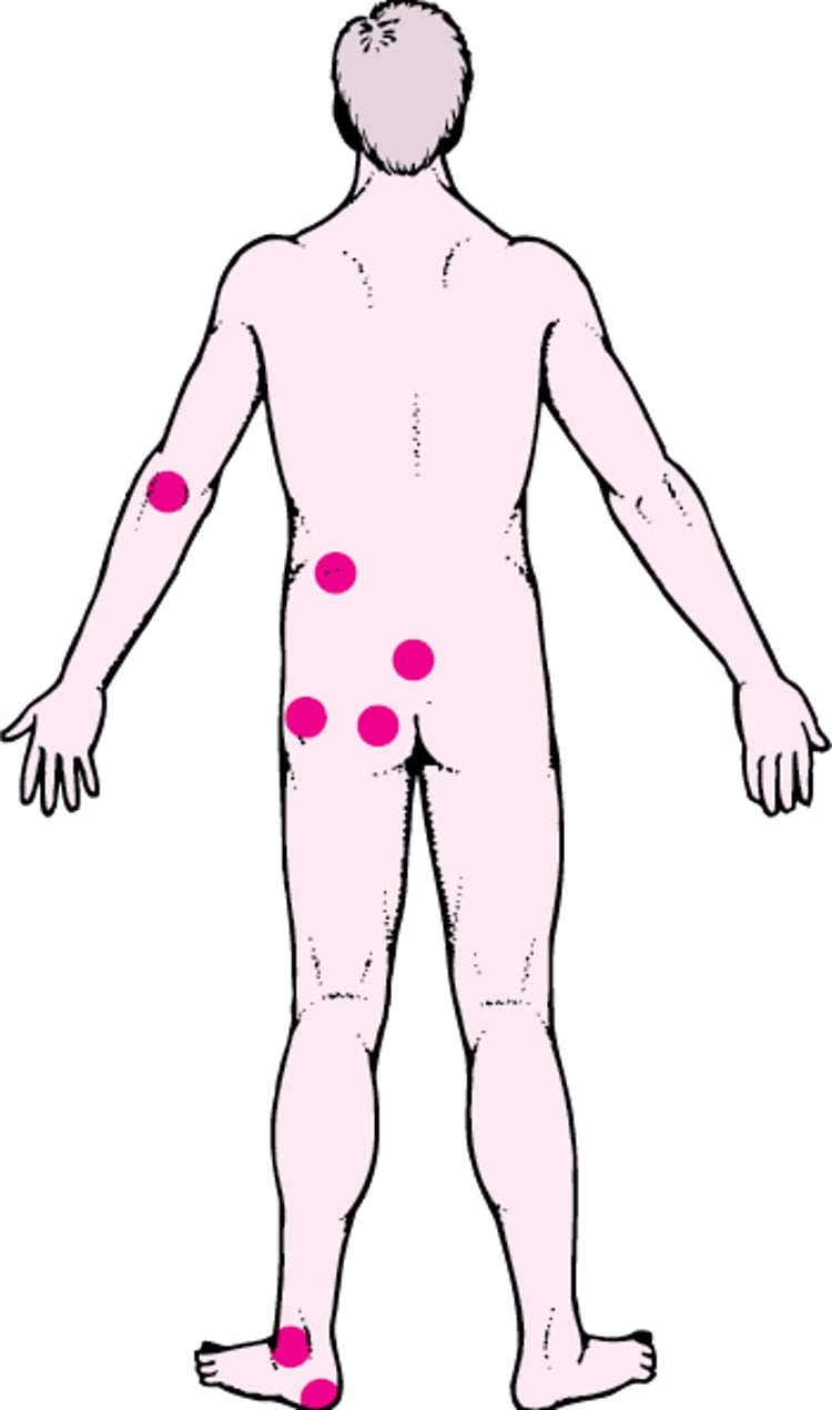Common Sites for Pressure Sores