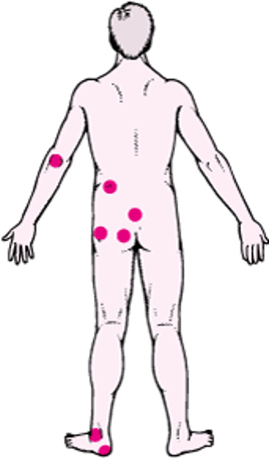 المواضِعُ الشائعة لقرحات الضغط