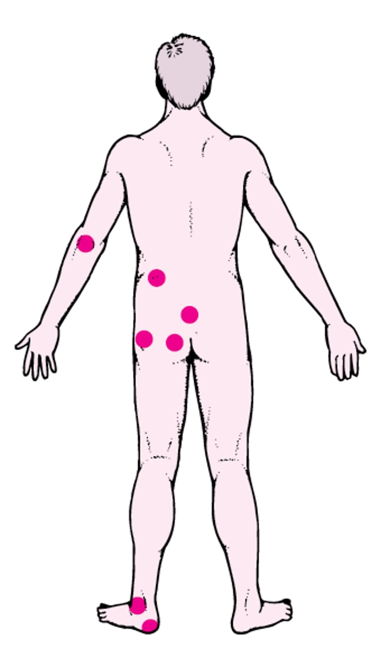 Häufige Stellen, an denen Druckgeschwüre entstehen