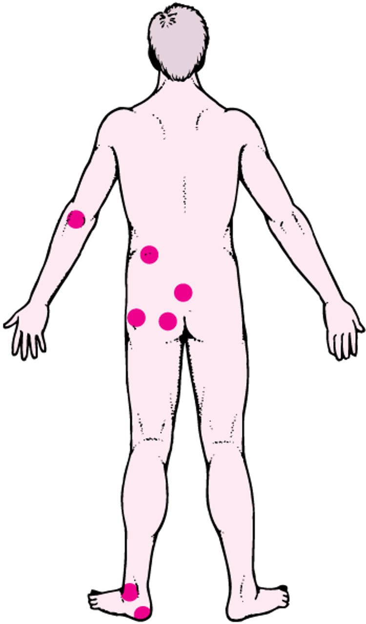 Lugares habituales de las úlceras por presión (úlceras de decúbito)