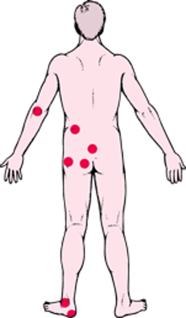 Обычные места возникновения пролежней