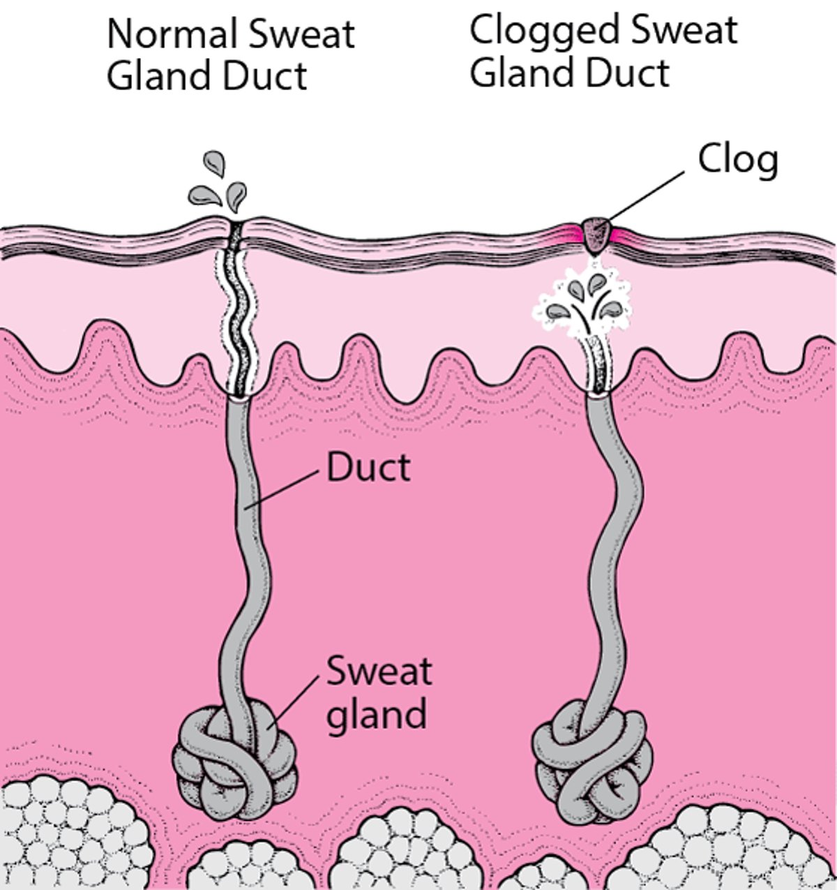What Causes Prickly Heat?