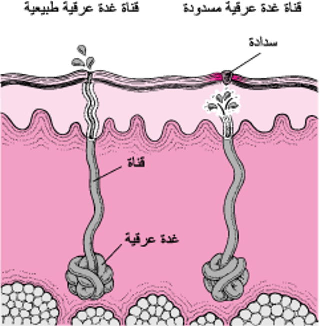 ما الذي يُسبِّبُ طفح الحرّ؟